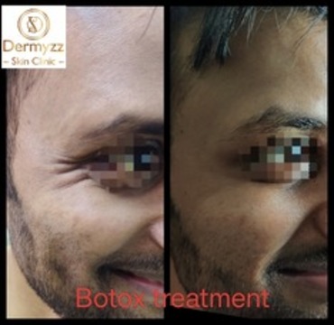Botox treatment at Dermyzz Skin Clinic