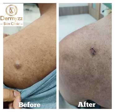 Cyst Removal Treatment at Dermyzz Skin Clinic