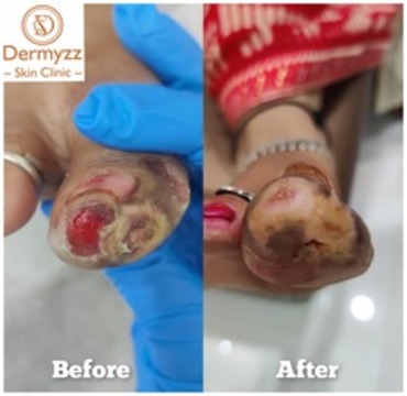 All Skin Treatment at Dermyzz Skin Clinic