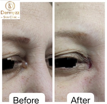 Hydrocystoma Removal Treatment at Dermyzz Skin Clinic