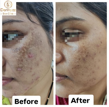 Melasma Treatment at Dermyzz Skin Clinic