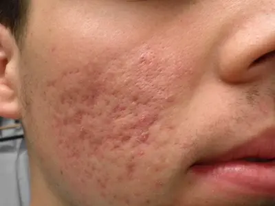 Best acne scar treatment in Dermyzz Skin Clinic in Andheri Mumbai