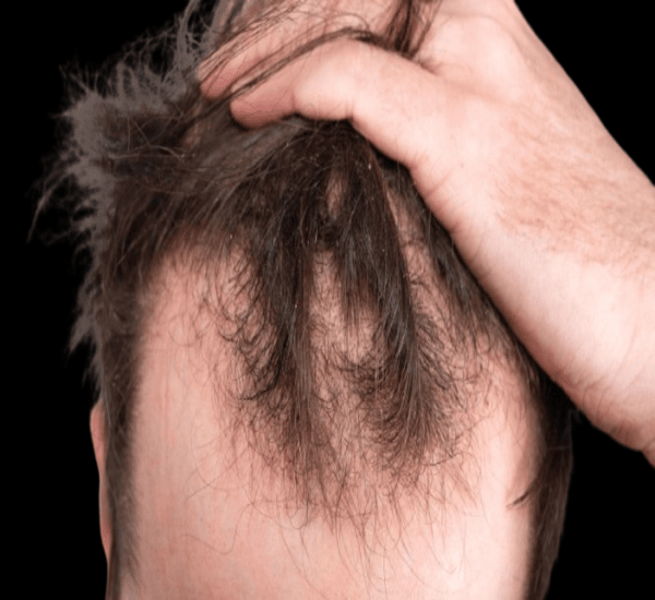 Best Hair Treatment Clinic in Mumbai