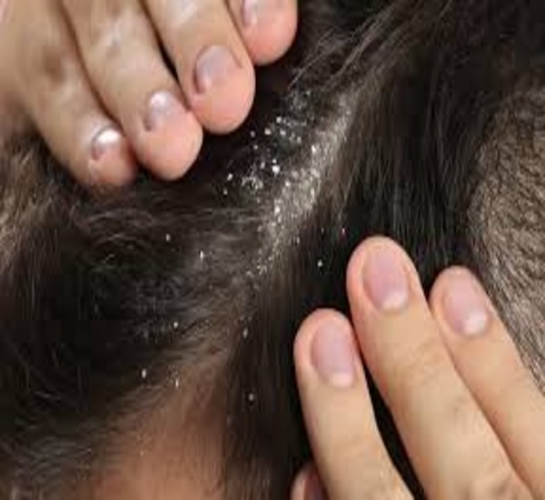 Best Dandruff Treatment Clinic in Mumbai