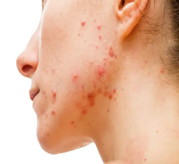 Best acne or pimples Treatment in Mumbai