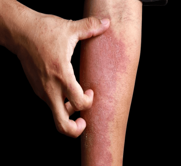 Best Eczema Treatment Clinic in Mumbai