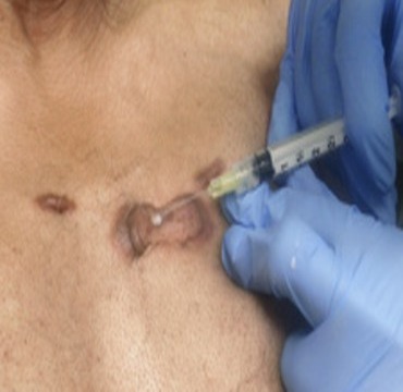 Keloid treatment at Dermyzz Skin Clinic