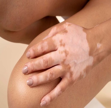 Vitiligo treatment at Dermyzz Skin Clinic