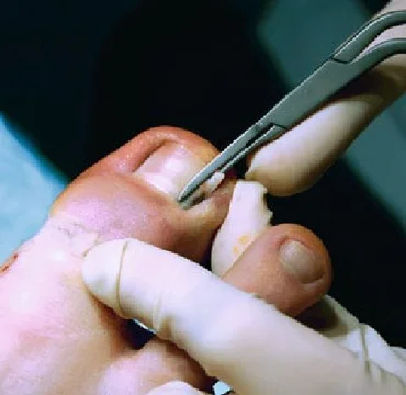 Ingrown toe-nail surgery at Dermyzz Skin Clinic