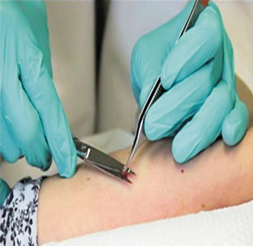 Skin Biopsy surgery at Dermyzz skin clinic
