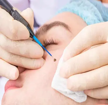 Wart or Mole Removal Surgery at Dermyzz Skin Clinic